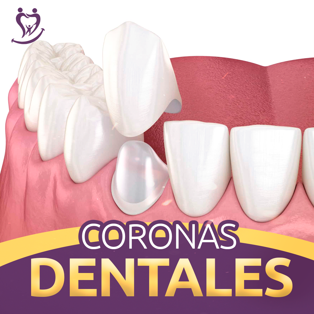 Imagen ilustrativa de coronas dentales personalizadas