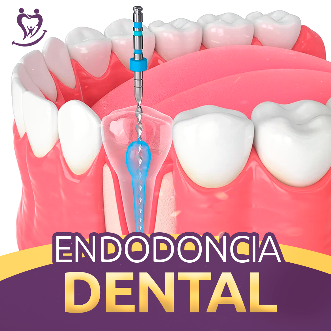 Tratamiento de endodoncia dental
