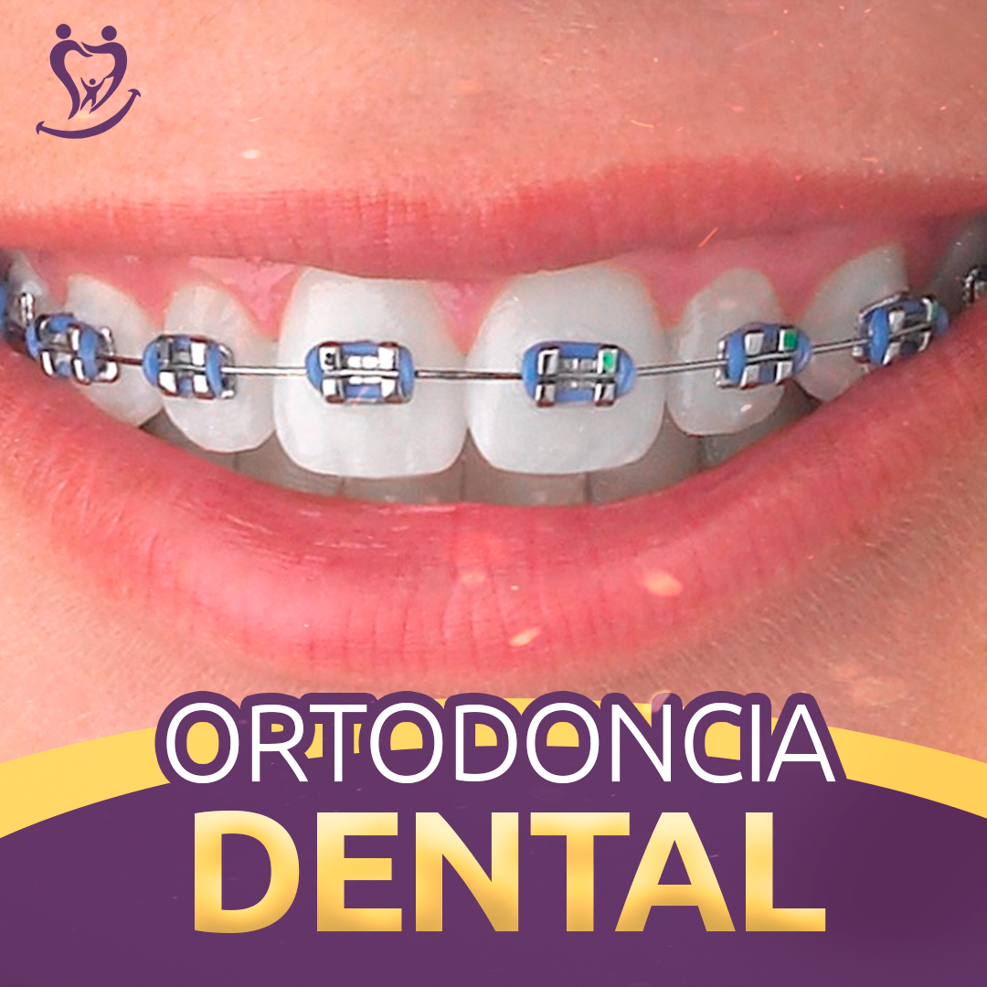 Imagen ilustrativa de tratamiento de ortodoncia dental
